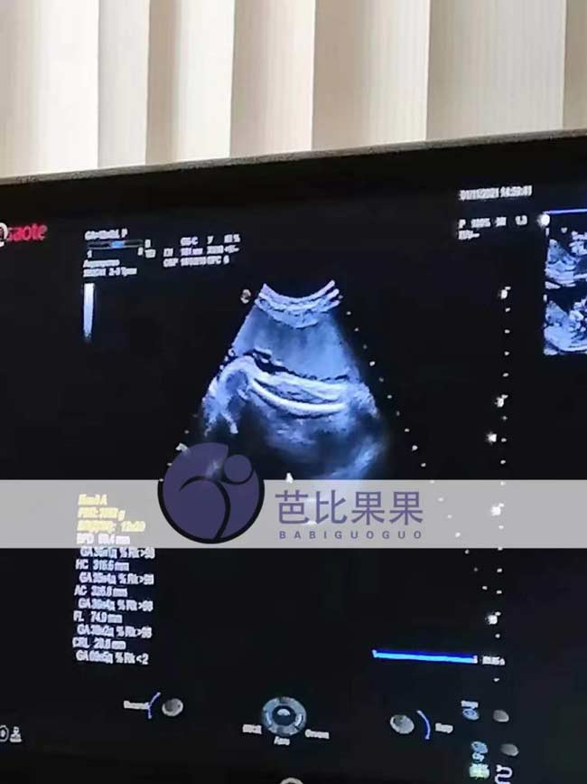 乌克兰代理孕母36周孕检