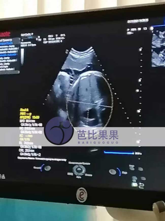 乌克兰代理孕母36周孕检