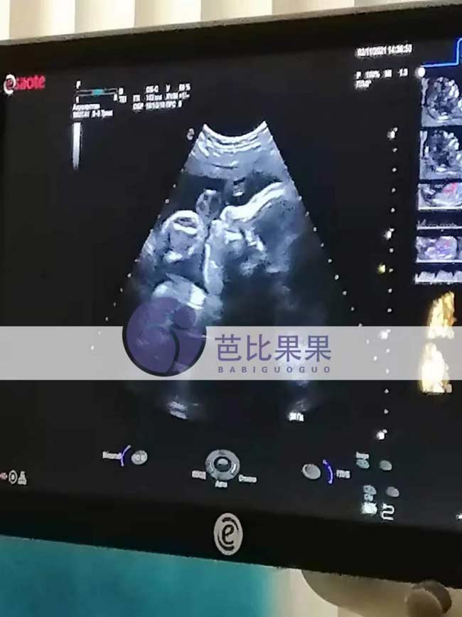 乌克兰孕妈到医院做检查