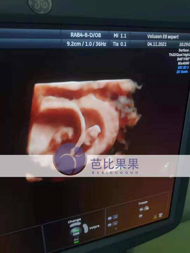 乌克兰孕妈到医院做B超