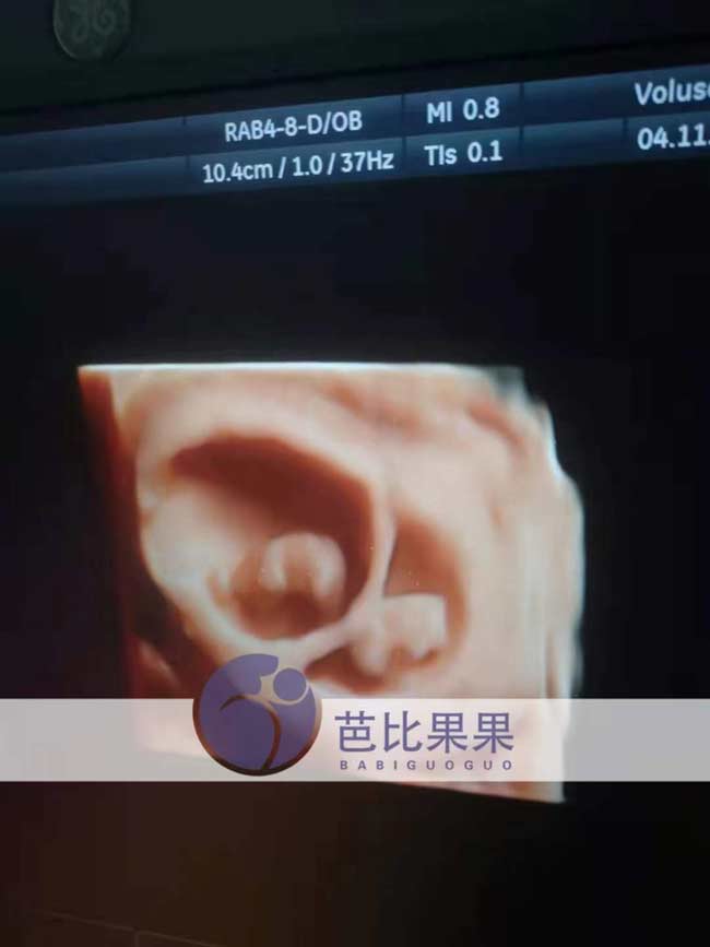 乌克兰孕妈到医院做B超