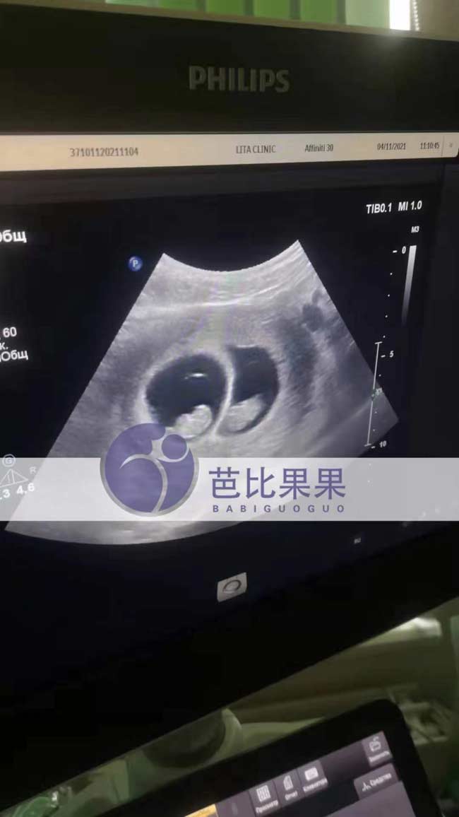 乌克兰孕妈到医院做B超