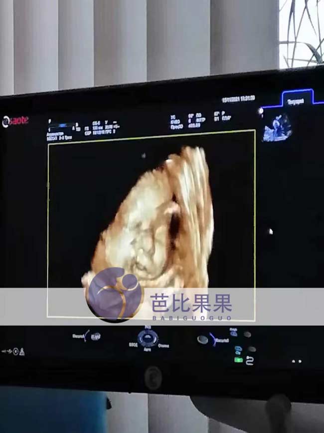 乌克兰试管孕妈做B超