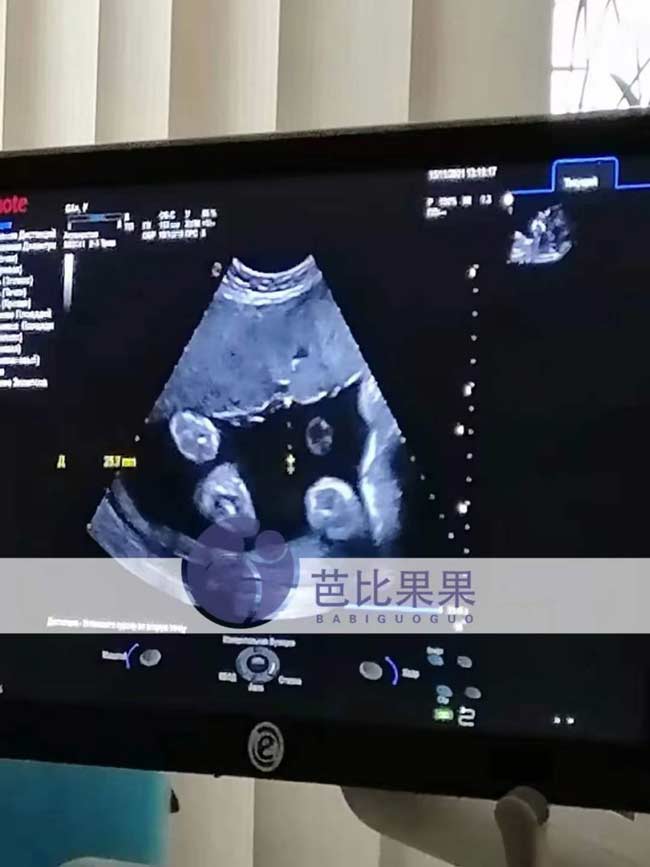 乌克兰试管孕妈做B超