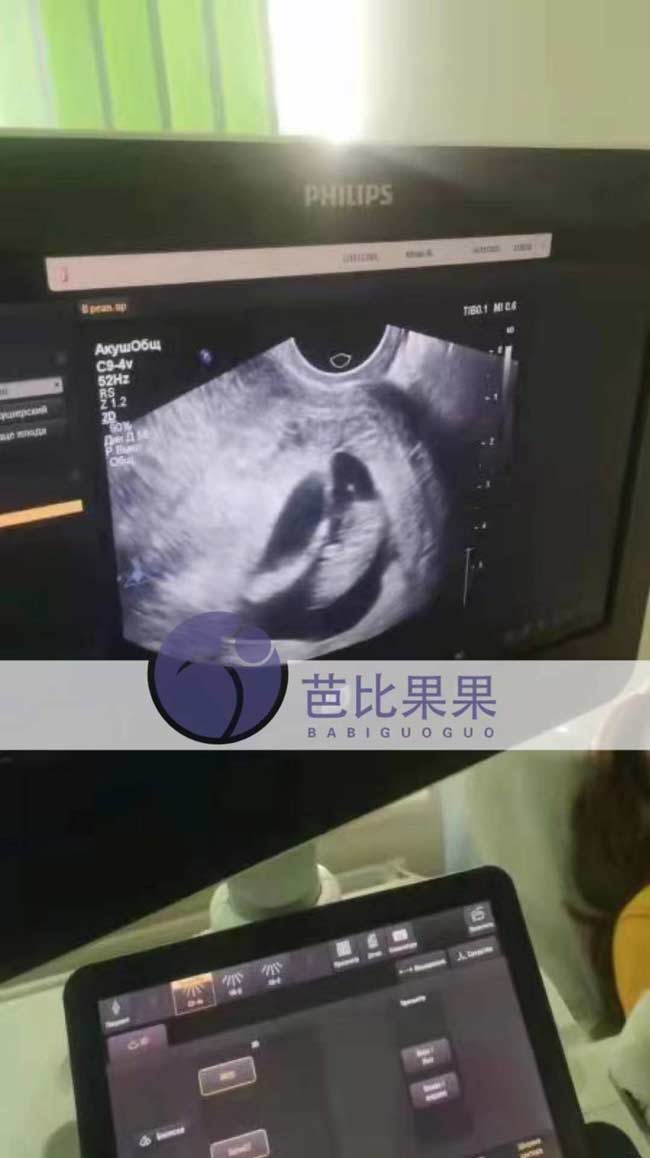 乌克兰孕妈第二次B超