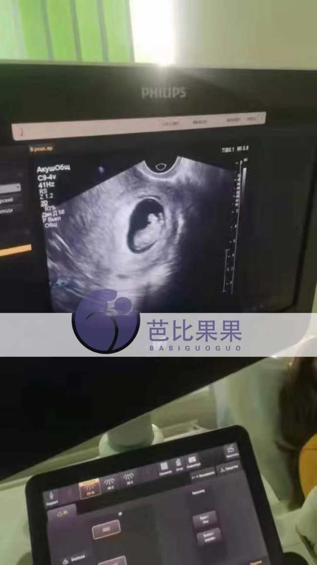 乌克兰孕妈第二次B超