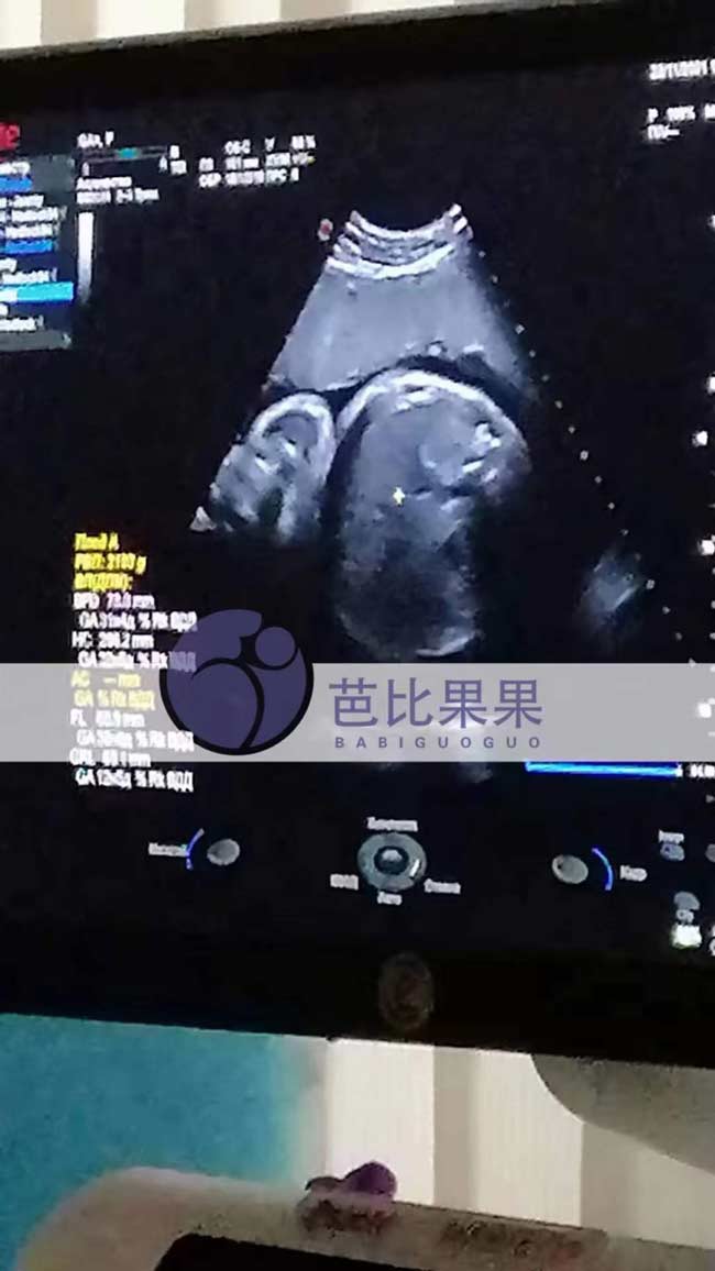 乌克兰试管孕做B超