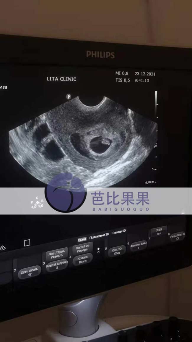 乌克兰孕母B超