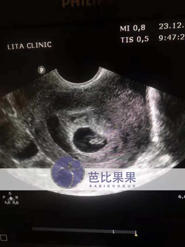 乌克兰孕母B超