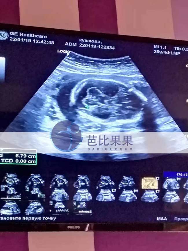 乌克兰试管孕妈做B超
