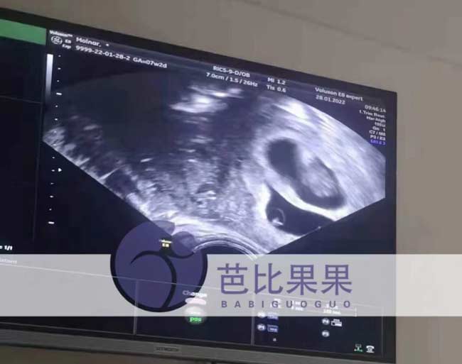 乌克兰孕妈首次B超