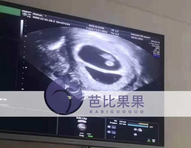 乌克兰孕妈首次B超