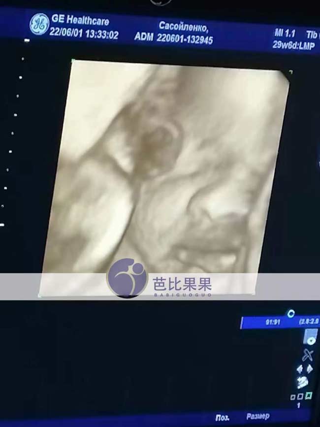 乌克兰试管妈妈B超