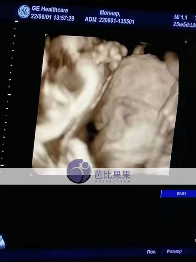 乌克兰试管妈妈做四维彩超