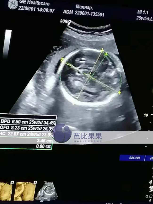乌克兰试管妈妈做四维彩超