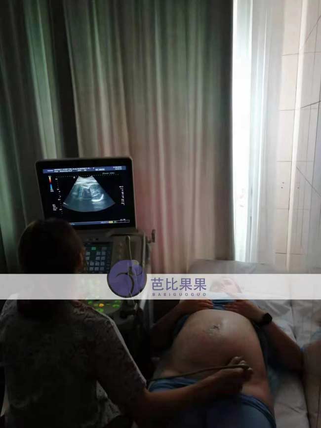 乌克兰试管妈妈做B超
