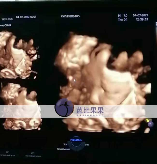 乌克兰试管妈妈做四维彩超