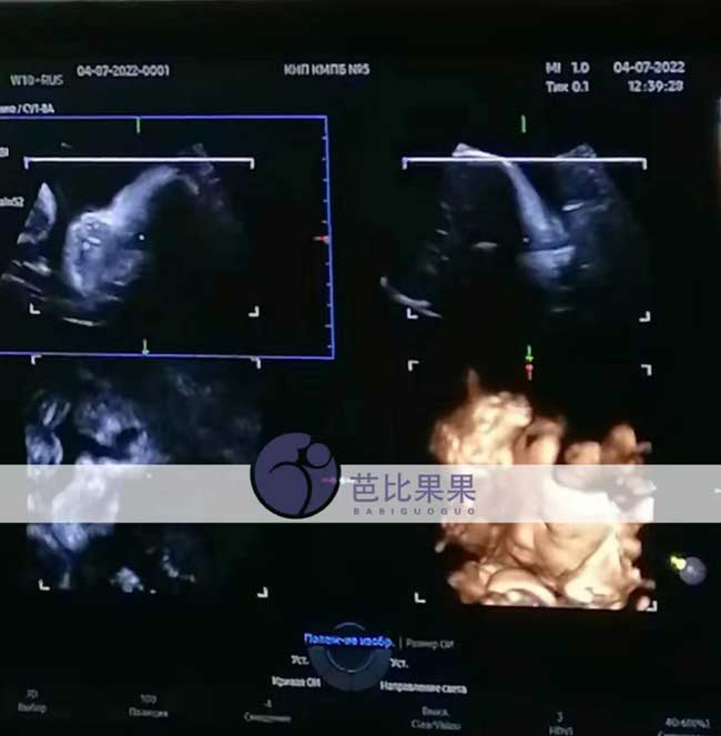 乌克兰试管妈妈做四维彩超