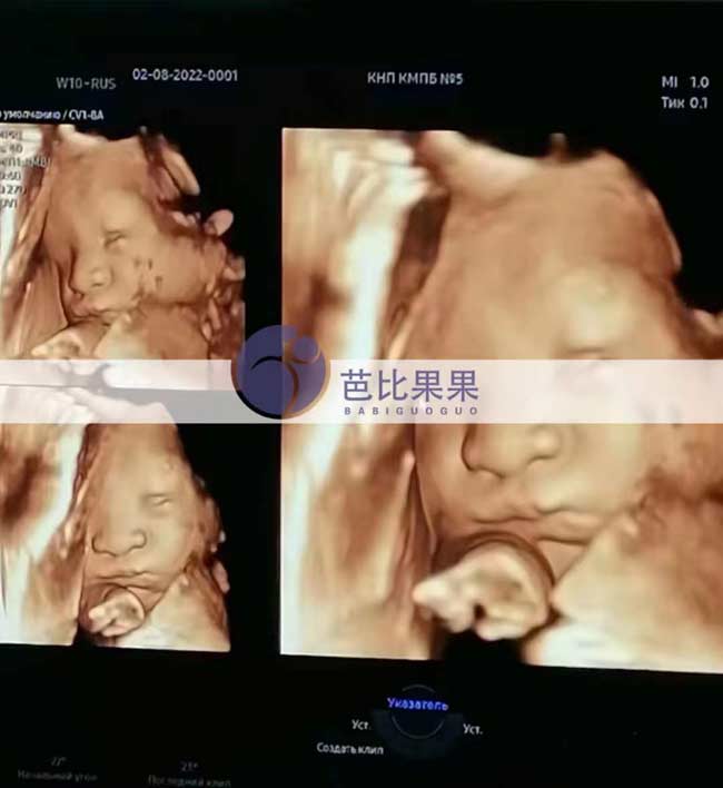 乌克兰试管妈妈四维彩超
