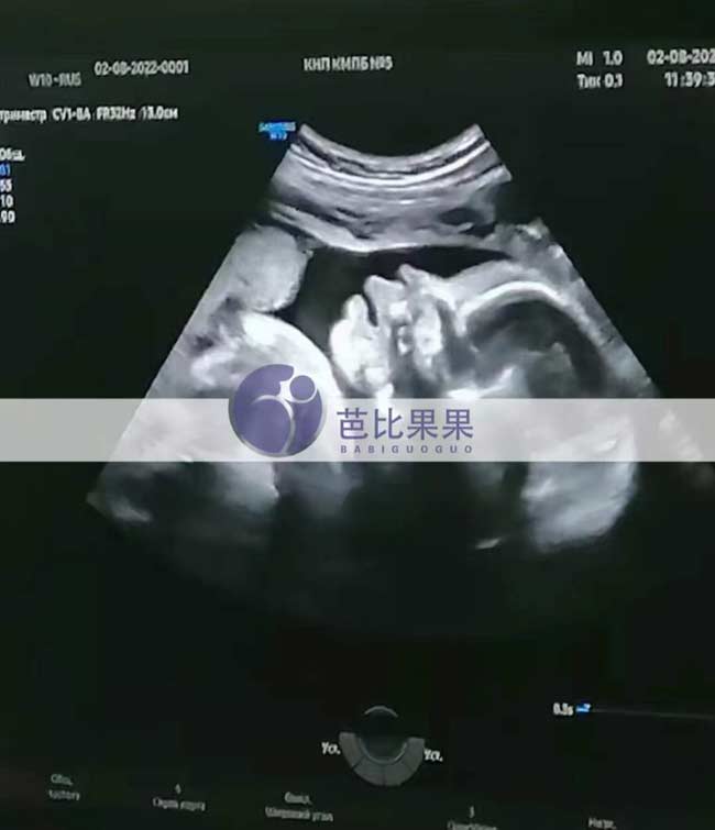 乌克兰试管妈妈四维彩超