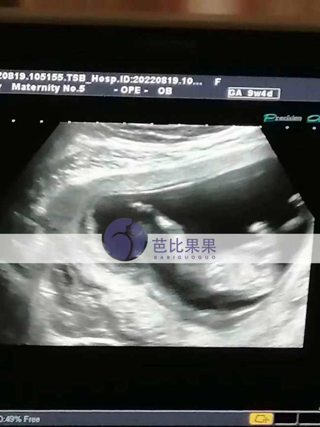 乌克兰试管B超