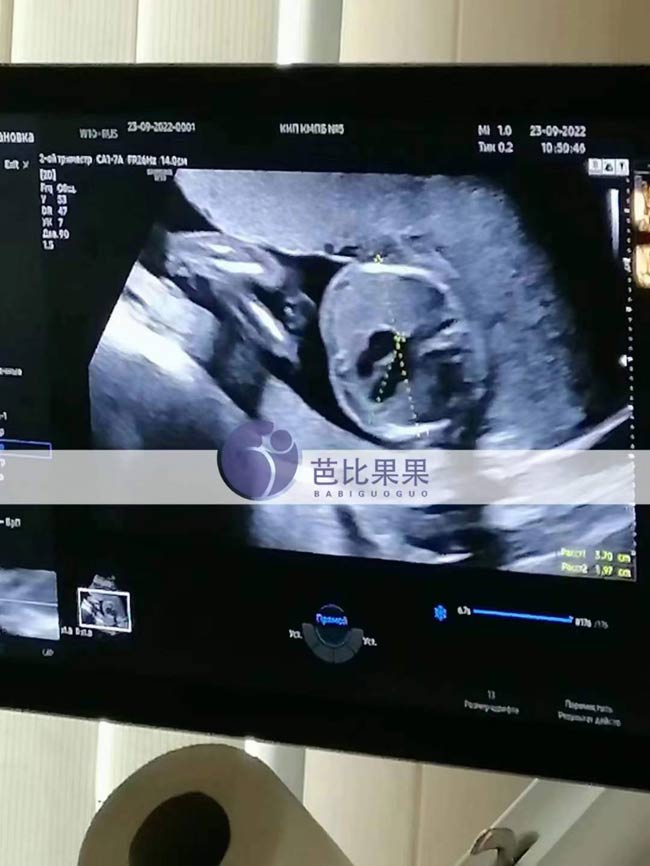 乌克兰试管B超