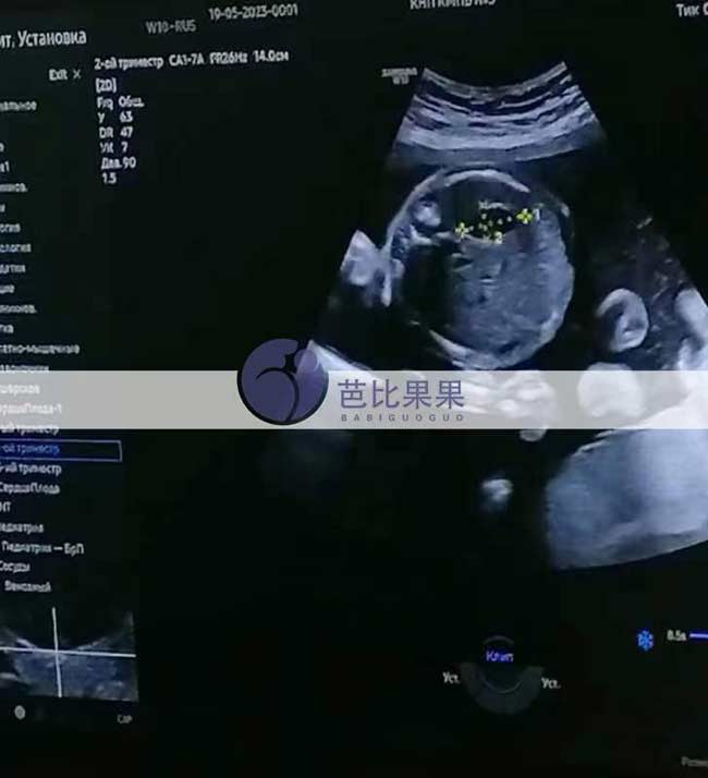 乌克兰试管妈妈四维彩超