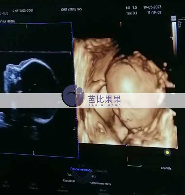 乌克兰试管妈妈四维彩超