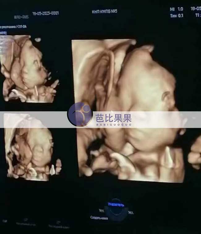 乌克兰试管妈妈四维彩超