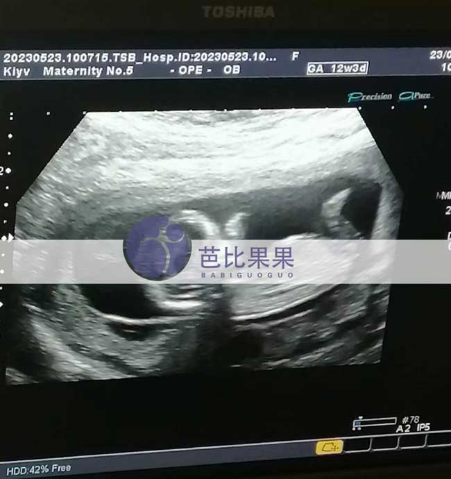 乌克兰试管妈妈孕12周B超