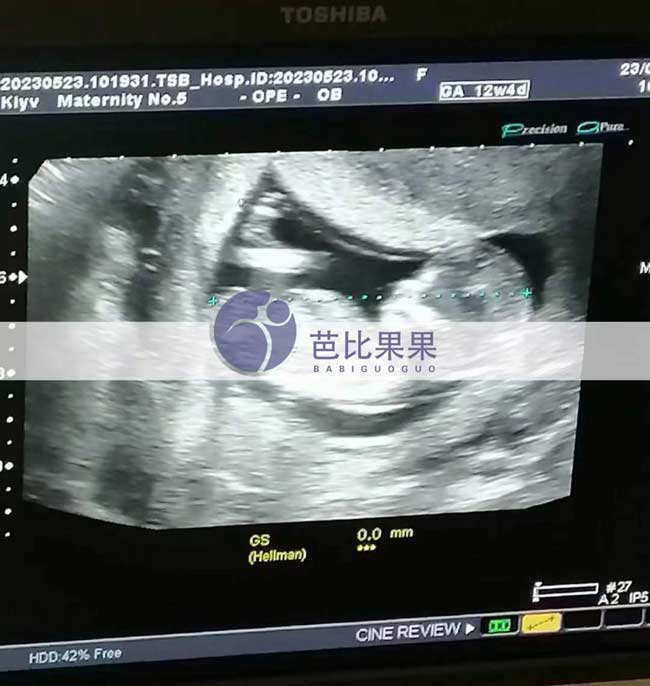 乌克兰试管妈妈孕12周B超