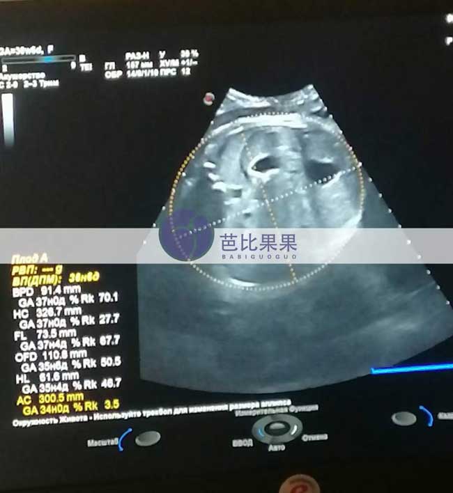 乌克兰试管妈妈做B超
