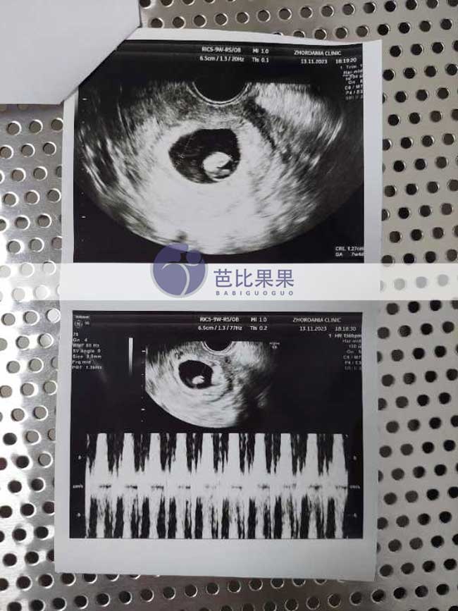 格鲁吉亚试管妈妈首次B超