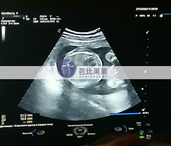 乌克兰试管妈妈孕检
