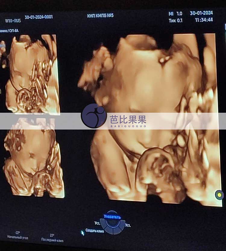 乌克兰试管妈妈做四维彩超
