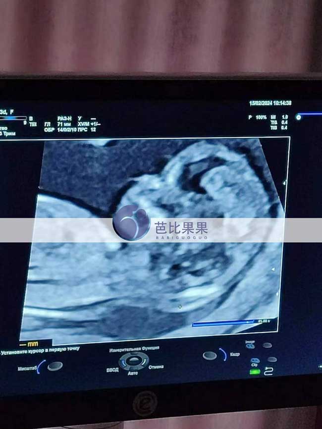 乌克兰试管妈妈孕12周B超