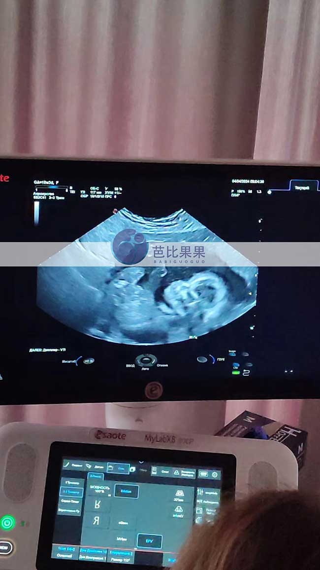 乌克兰试管妈妈20周孕检