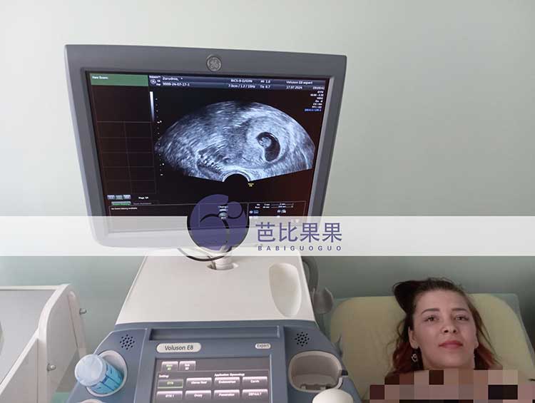选择在乌克兰DY的C女士家匹配的试管妈妈做第二次B超