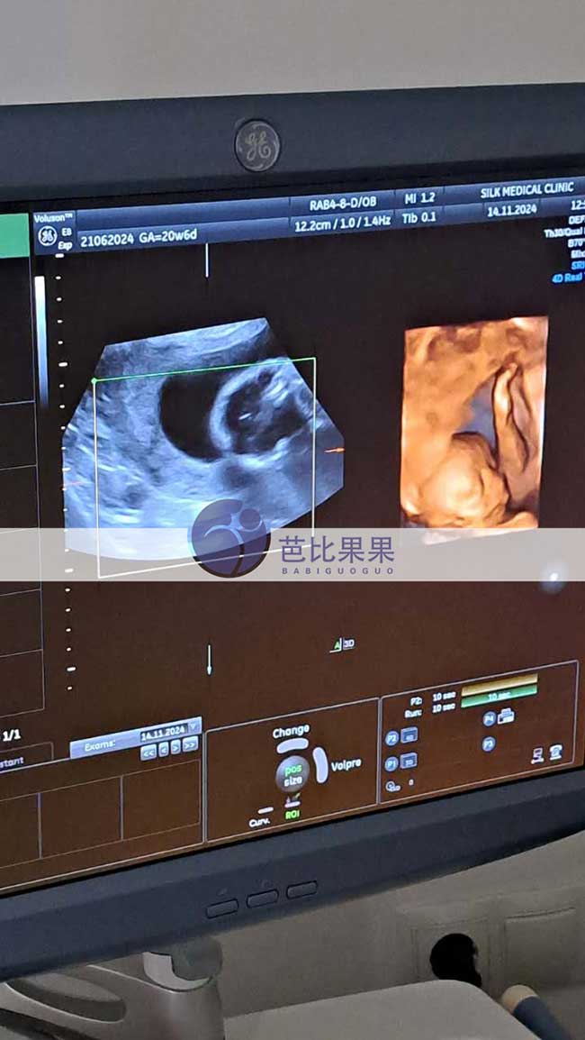 乌克兰试管妈妈四维彩超