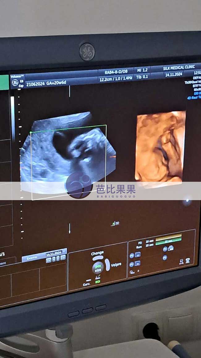 乌克兰试管妈妈四维彩超