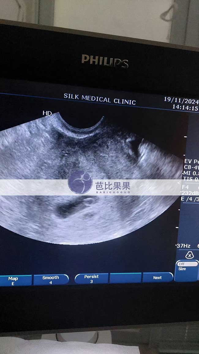 试管妈妈做首次B超