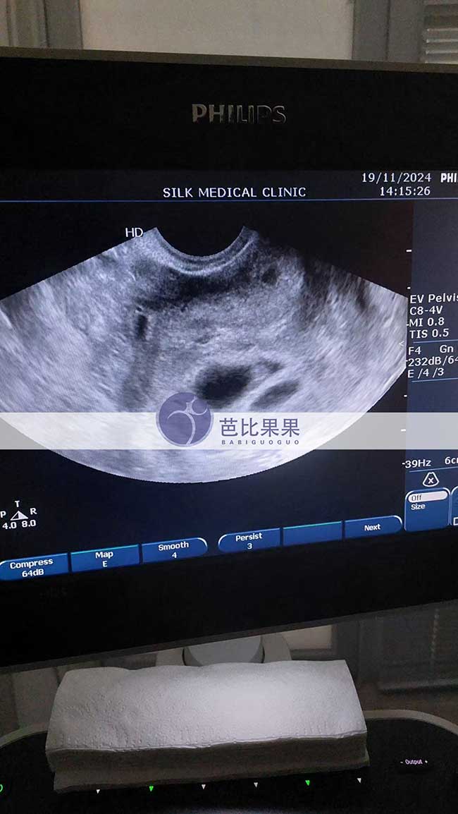 试管妈妈做首次B超