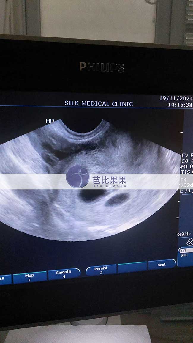 试管妈妈做首次B超
