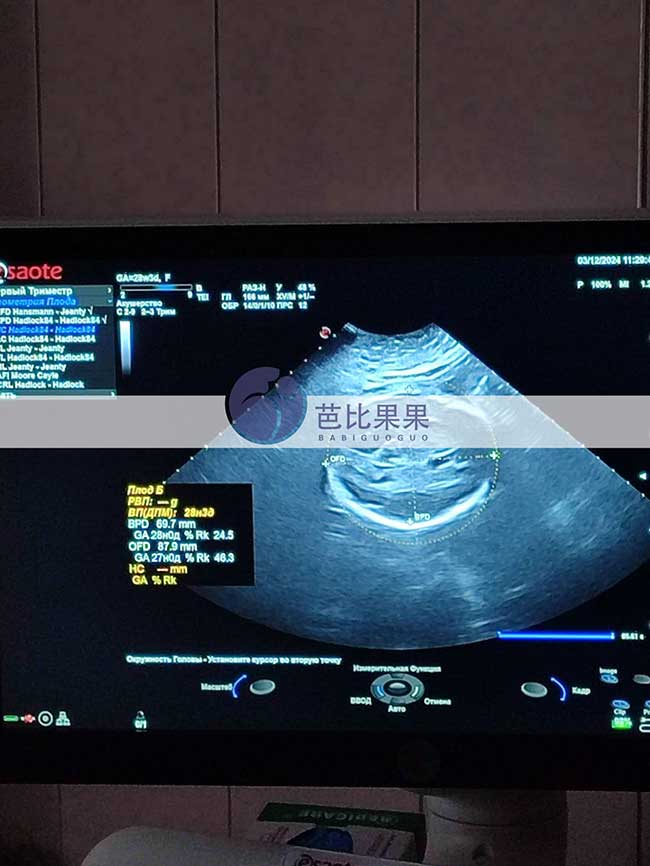 试管妈妈做B超