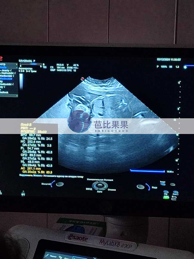 试管妈妈做B超