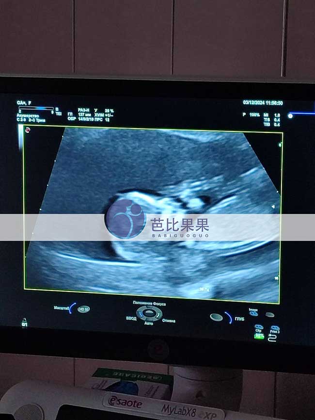 试管妈妈孕13周B超