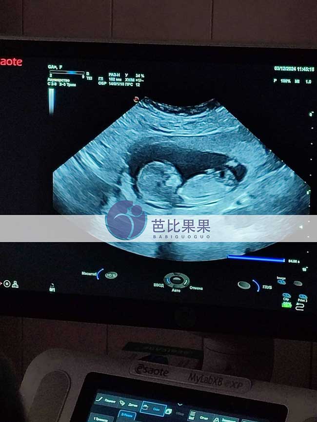 试管妈妈孕13周B超