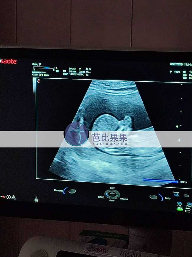 试管妈妈孕13周B超