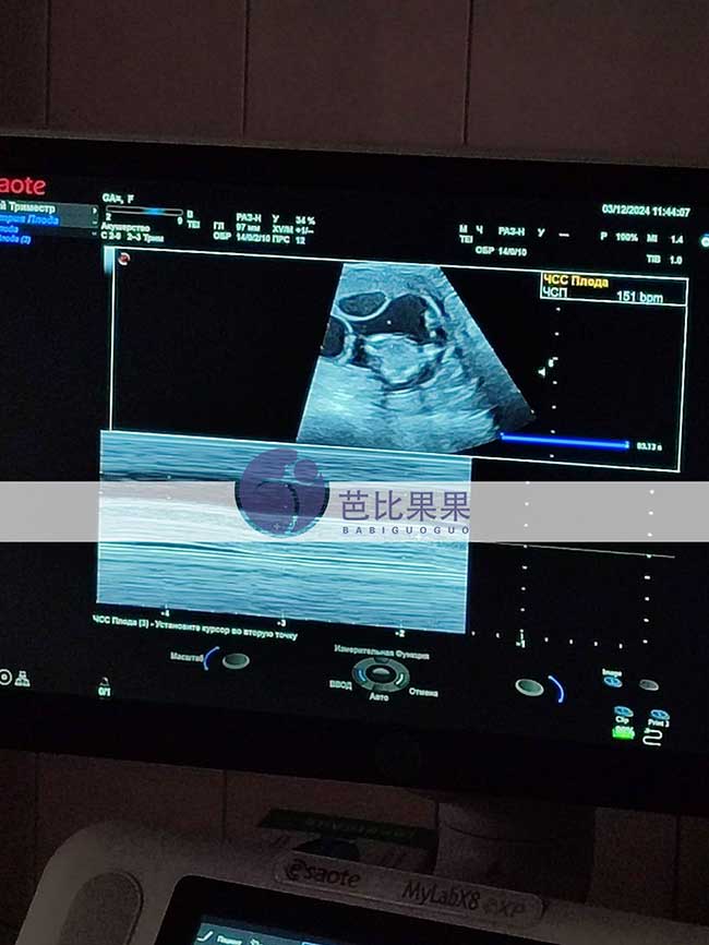 试管妈妈孕13周B超