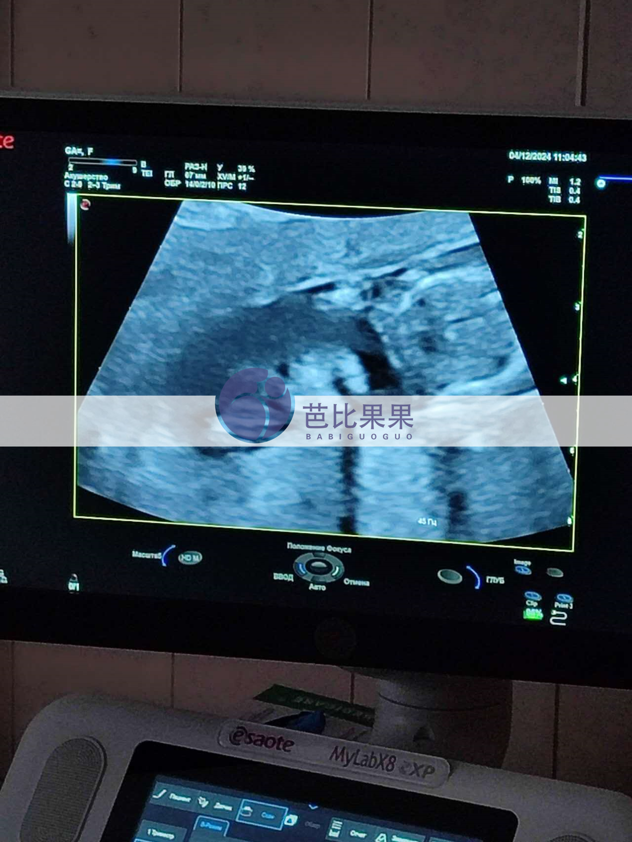 试管妈妈孕13周